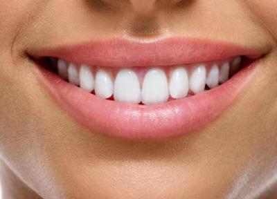 کامپوزیت دندان چگونه است؟